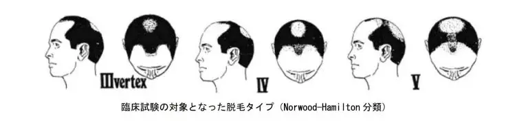 デュタステリドの臨床試験はノーウッド-ハミルトン分類Ⅲ〜Ⅴが対象